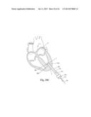 DEVICES AND METHODS FOR MINIMALLY-INVASIVE SURGICAL PROCEDURES diagram and image