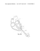 DEVICES AND METHODS FOR MINIMALLY-INVASIVE SURGICAL PROCEDURES diagram and image