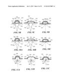 Methods and Devices for Applying Closed Incision Negative Pressure Wound     Therapy diagram and image