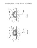 Methods and Devices for Applying Closed Incision Negative Pressure Wound     Therapy diagram and image