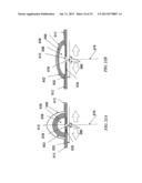 Methods and Devices for Applying Closed Incision Negative Pressure Wound     Therapy diagram and image