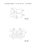 SYSTEMS AND METHODS FOR PERFORMING SPINAL FUSION diagram and image