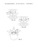 SYSTEMS AND METHODS FOR PERFORMING SPINAL FUSION diagram and image