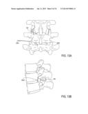 SYSTEMS AND METHODS FOR PERFORMING SPINAL FUSION diagram and image