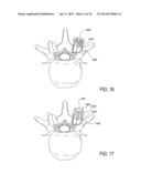 SYSTEMS AND METHODS FOR PERFORMING SPINAL FUSION diagram and image