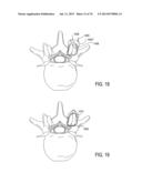 SYSTEMS AND METHODS FOR PERFORMING SPINAL FUSION diagram and image