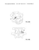 SYSTEMS AND METHODS FOR PERFORMING SPINAL FUSION diagram and image