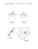 SYSTEMS AND METHODS FOR PERFORMING SPINAL FUSION diagram and image