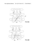 SYSTEMS AND METHODS FOR PERFORMING SPINAL FUSION diagram and image