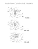 SYSTEMS AND METHODS FOR PERFORMING SPINAL FUSION diagram and image