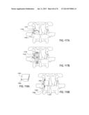 SYSTEMS AND METHODS FOR PERFORMING SPINAL FUSION diagram and image