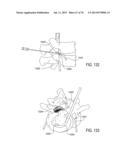 SYSTEMS AND METHODS FOR PERFORMING SPINAL FUSION diagram and image