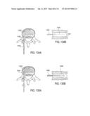 SYSTEMS AND METHODS FOR PERFORMING SPINAL FUSION diagram and image