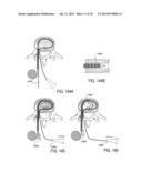 SYSTEMS AND METHODS FOR PERFORMING SPINAL FUSION diagram and image