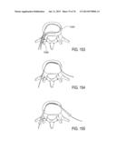 SYSTEMS AND METHODS FOR PERFORMING SPINAL FUSION diagram and image