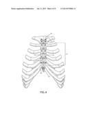 METHOD AND SYSTEM FOR LONGITUDINAL CLOSURE OF DISSECTED STERNUMS diagram and image