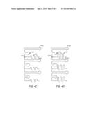 LOW PROFILE STENT WITH FLEXIBLE LINK diagram and image