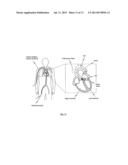 CATHETER SYSTEM FOR INTRODUCING AN EXPANDABLE HEART VALVE STENT INTO THE     BODY OF A PATIENT, INSERTION SYSTEM WITH A CATHETER SYSTEM AND MEDICAL     DEVICE FOR TREATMENT OF A HEART VALVE DEFECT diagram and image
