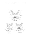 IMPLANTED TONGUE PULLING DEVICE, PULL PLATE, PULL LINE, RETRACTOR AND     METHOD diagram and image