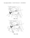 IMPLANTED TONGUE PULLING DEVICE, PULL PLATE, PULL LINE, RETRACTOR AND     METHOD diagram and image