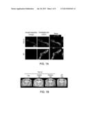 METHODS OF TREATING CEREBRAL AMYLOID ANGIOPATHY diagram and image