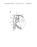 METHODS, SYSTEMS, AND DEVICES FOR RESIZABLE INTRA-ATRIAL SHUNTS diagram and image