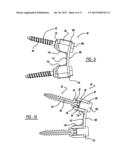 DISC DISTRACTION DEVICE diagram and image