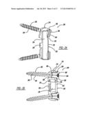 DISC DISTRACTION DEVICE diagram and image