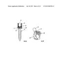 Spinal Fixation Method and Apparatus diagram and image