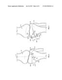 PATIENT-SPECIFIC HIGH TIBIA OSTEOTOMY diagram and image