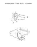 PATIENT-SPECIFIC HIGH TIBIA OSTEOTOMY diagram and image