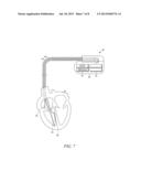 RATE ADAPTIVE CARDIAC PACING SYSTEMS AND METHODS diagram and image