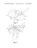 FIXED-BEARING KNEE PROSTHESIS HAVING INTERCHANGEABLE COMPONENTS diagram and image