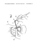 DENTAL INSTRUMENT FOR CLEANING TEETH diagram and image