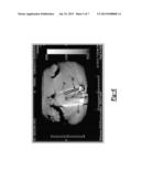 Automatic Implant Detection From Image Artifacts diagram and image