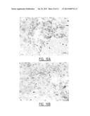 METHOD FOR IDENTIFYING A SUBJECT AT RISK OF DEVELOPING HEART FAILURE BY     DETERMINING THE LEVEL OF GALECTIN-3 OR THROMBOSPONDIN-2 diagram and image