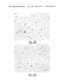 METHOD FOR IDENTIFYING A SUBJECT AT RISK OF DEVELOPING HEART FAILURE BY     DETERMINING THE LEVEL OF GALECTIN-3 OR THROMBOSPONDIN-2 diagram and image