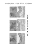 THE USE OF ALKYLATED SEMI-SYNTHETIC GLYCOSAMINOGLYCOSAN ETHERS FOR THE     TREATMENT OF DENTAL DISORDERS diagram and image