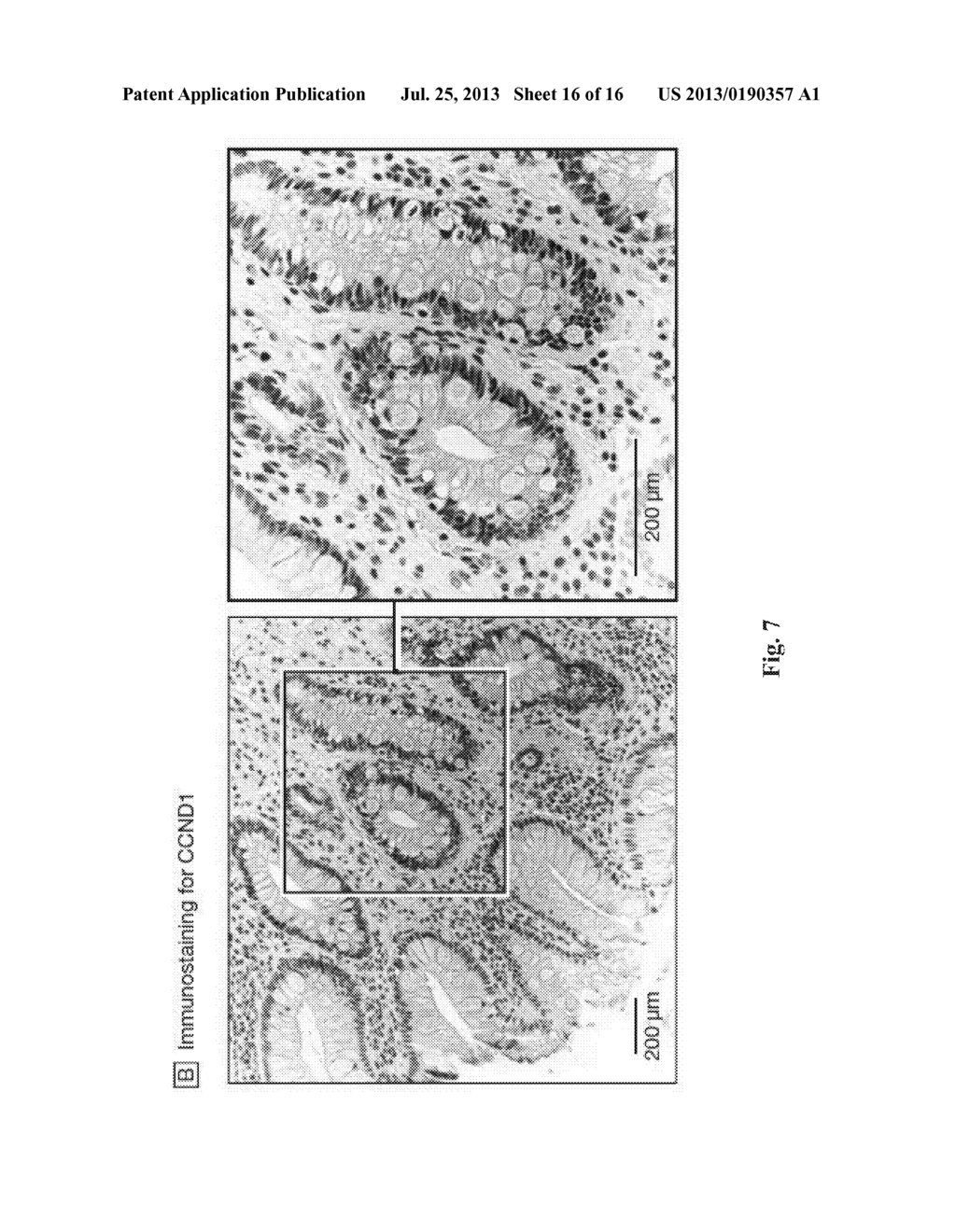 COMPOSITIONS AND METHODS FOR ASSESSING AND TREATING A PRECURSOR LESION     AND/OR ESOPHAGEAL CANCER - diagram, schematic, and image 17