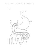 Methods and Devices for Treating Alzheimer s Disease diagram and image