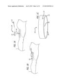 DISSECTION HANDPIECE AND METHOD FOR REDUCING THE APPEARANCE OF CELLULITE diagram and image