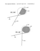 DISSECTION HANDPIECE AND METHOD FOR REDUCING THE APPEARANCE OF CELLULITE diagram and image