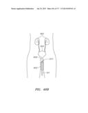 SYSTEMS AND METHODS FOR PERFORMING MINIMALLY INVASIVE PROCEDURES diagram and image