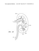 SYSTEMS AND METHODS FOR PERFORMING MINIMALLY INVASIVE PROCEDURES diagram and image