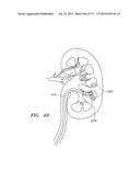 SYSTEMS AND METHODS FOR PERFORMING MINIMALLY INVASIVE PROCEDURES diagram and image