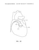 SYSTEMS AND METHODS FOR PERFORMING MINIMALLY INVASIVE PROCEDURES diagram and image