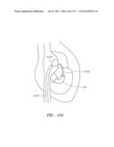 SYSTEMS AND METHODS FOR PERFORMING MINIMALLY INVASIVE PROCEDURES diagram and image