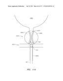 SYSTEMS AND METHODS FOR PERFORMING MINIMALLY INVASIVE PROCEDURES diagram and image