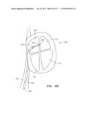 SYSTEMS AND METHODS FOR PERFORMING MINIMALLY INVASIVE PROCEDURES diagram and image