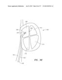 SYSTEMS AND METHODS FOR PERFORMING MINIMALLY INVASIVE PROCEDURES diagram and image